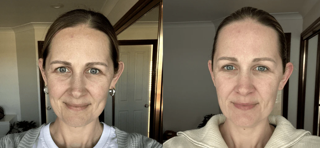 Rejuvenecimiento facial